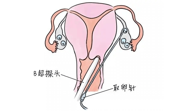 试管取卵手术对女性卵巢的伤害有哪些？