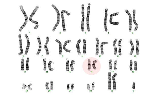 16号染色体非整倍体异常能做试管要孩子吗？