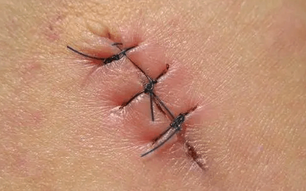 顺产时侧切伤口缝了四针严重吗？