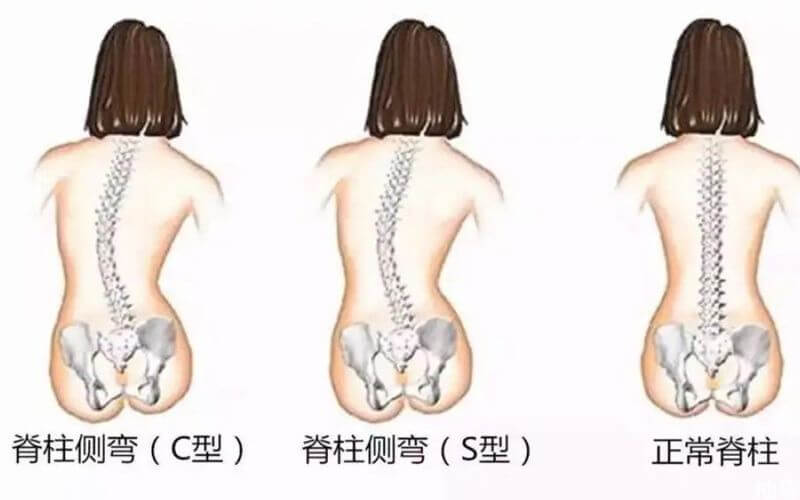 孕妇脊柱侧弯s型矫正后能成功顺产吗?