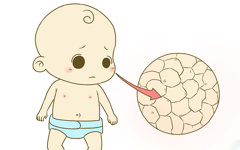 宝宝长湿疹后因为长期使用丝塔芙大白罐造成皮肤自身的保护能力下降