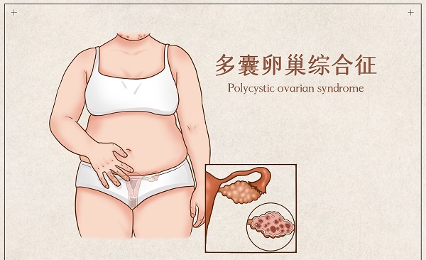 患多囊卵巢综合征还在吃药治疗的女性能吃柚子吗?