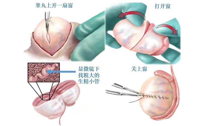 做试管通过睾丸取精子的手术过程