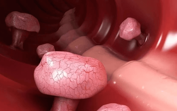 医生说的子宫内膜息肉组织到底是什么疾病?