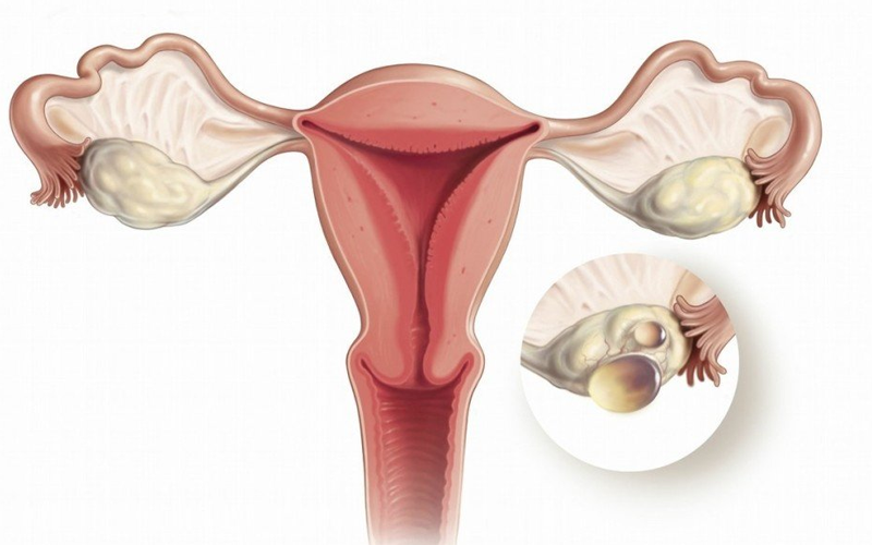 卵巢功能下降导致AMH低