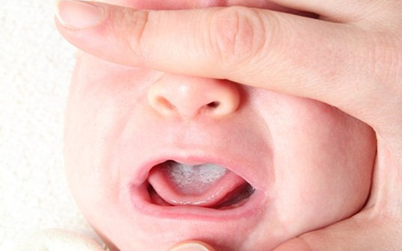 鹅口疮是婴幼儿常见的一种多发病