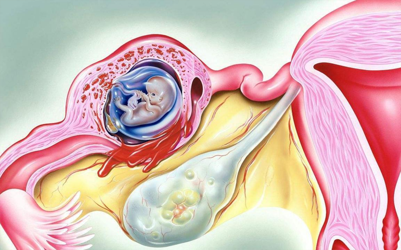 伞端宫外孕是指受精卵在输卵管的伞端部位着床