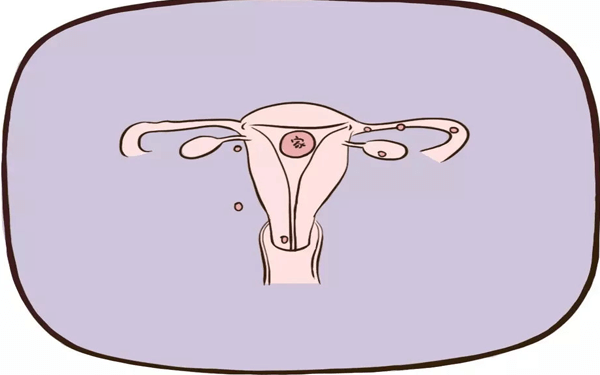 输卵管伞端宫外孕，是什么原因造成的？	