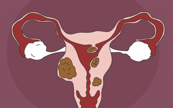 听说子宫肌瘤饮食有禁忌，具体不能吃什么食物？