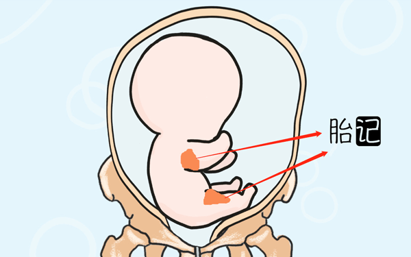 胎儿的胎记是怎样来的？遗传的可能性大吗？
