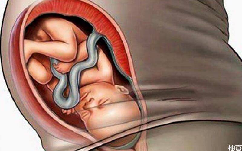 孕妇严重发烧影响胎儿发育