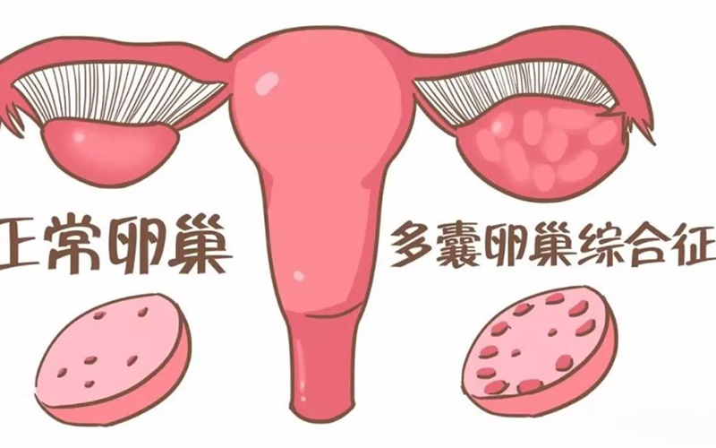 多囊卵巢一般促排3-5次才能怀上