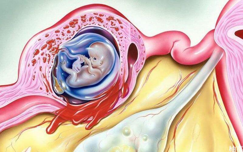 宫外孕是胎儿在输卵管妊娠