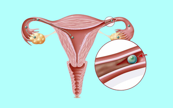 女性输卵管堵塞原因有5，白带异常、盆腔粘连屡见不鲜