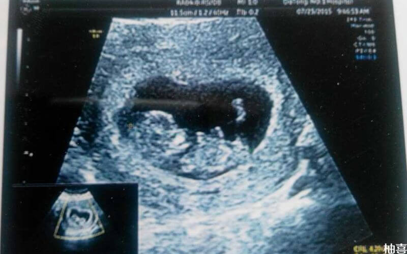 b超显示下的胎儿
