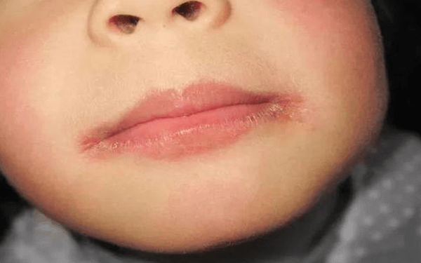 为什么冬天小孩的嘴巴周围一圈会出现红肿爆裂现象？
