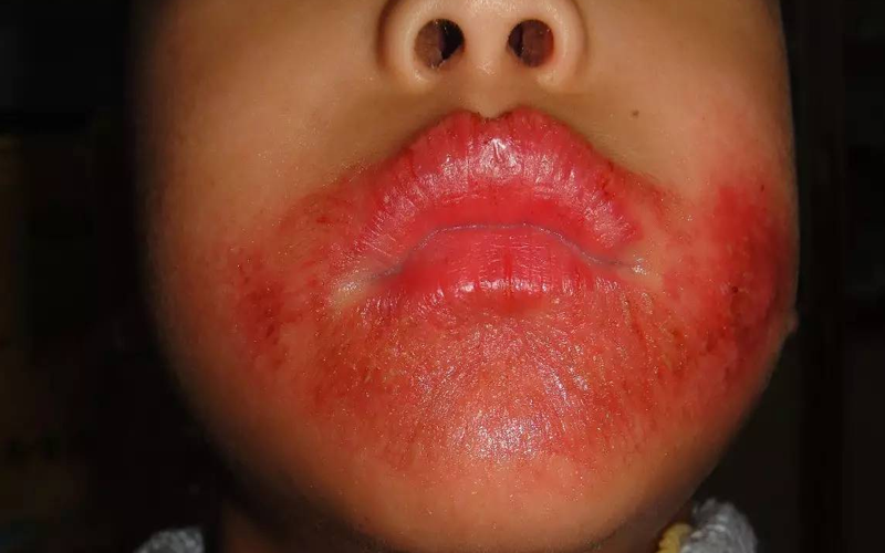 小孩一到冬天嘴巴就会出现一圈红肿爆裂的现象