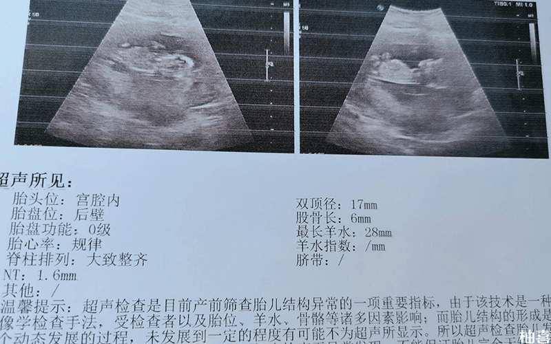 孕13周nt男孩图男宝图片