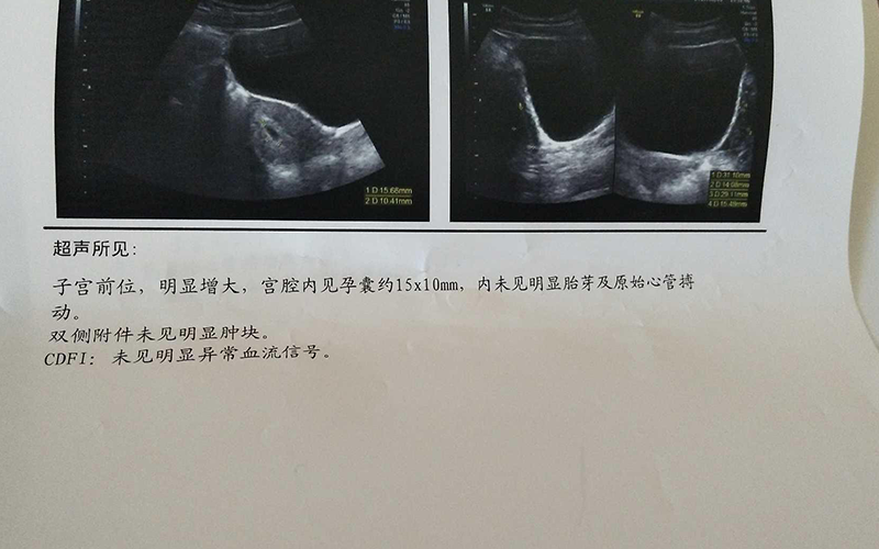 孕囊是椭圆形可能是女宝宝
