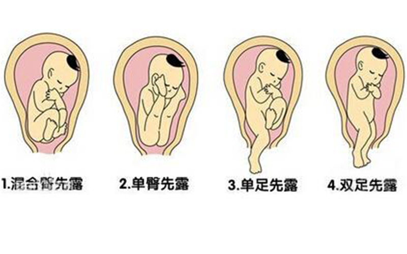 胎儿臀位姿势图