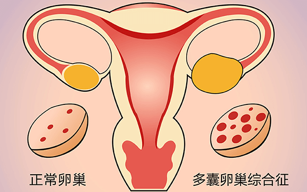患有多囊卵巢的女性自然怀孕的几率一般有多大?