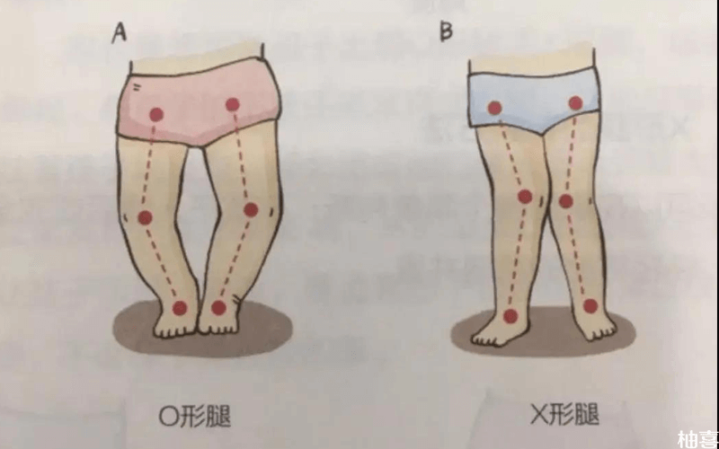 儿童罗圈腿要预防