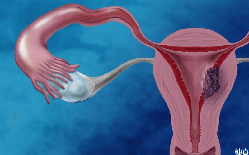 女性因子宫疾病不得已摘除卵巢