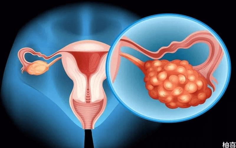 多囊卵巢会导致宫颈机能不全吗