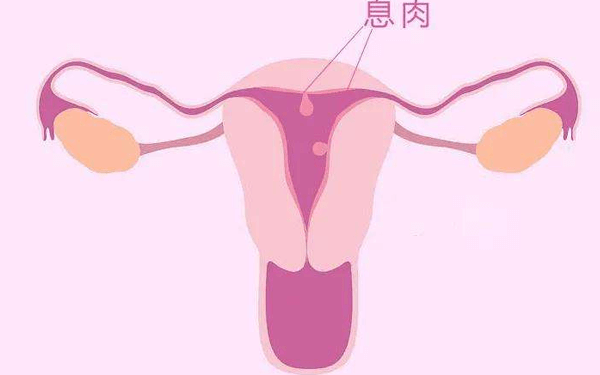 子宫内膜息肉9mm需要刮宫才能治疗吗？