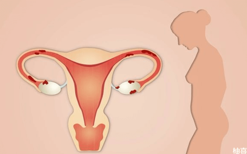 子宫内膜息肉需不需要刮宫处理