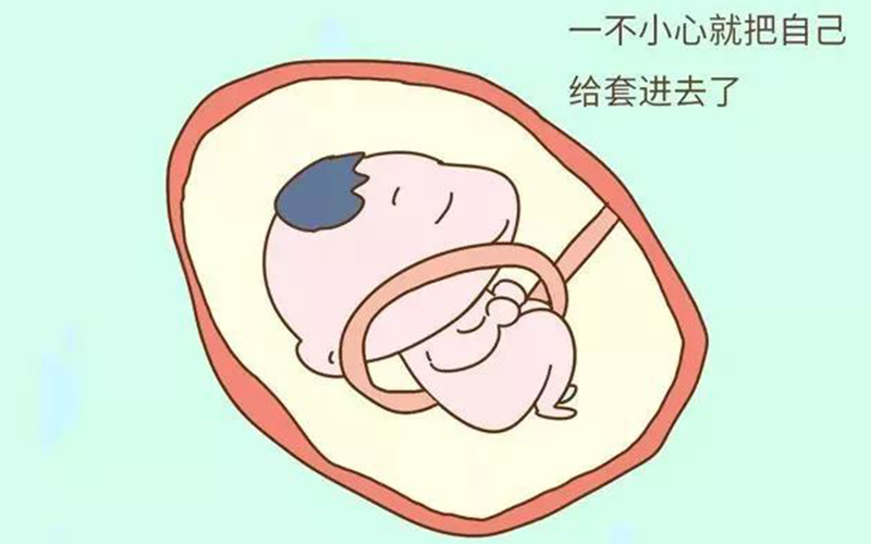 脐带绕颈可能会使胎儿宫内缺氧