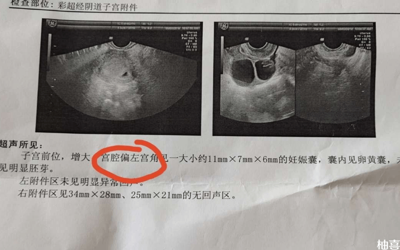 报告单显示孕囊偏左侧宫角