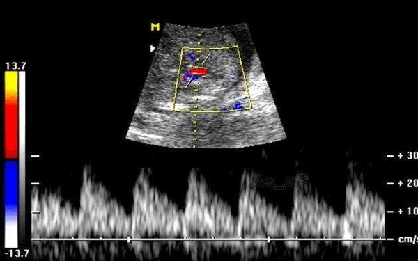 从脐动脉血流sd值怎么能看出生男女？