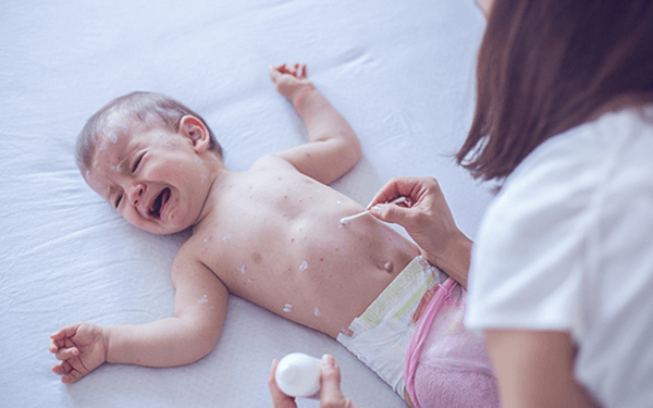 1个月新生婴儿脸上的胎毒怎样科学的去除?