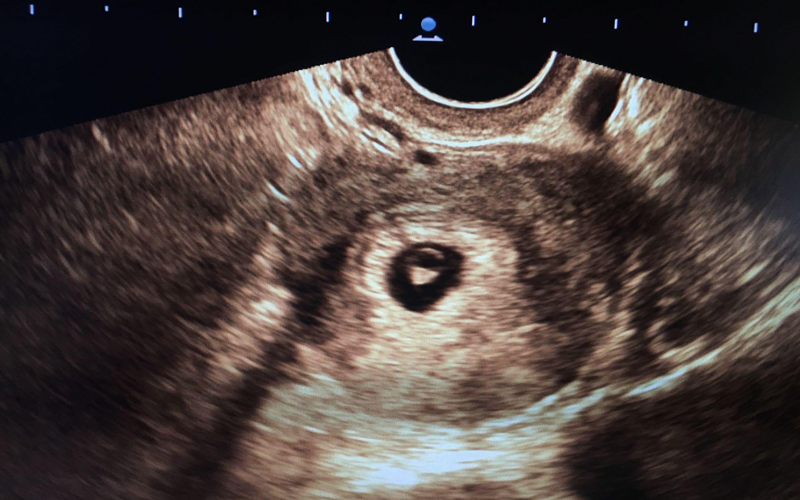 女孩胎囊图片两个月图片