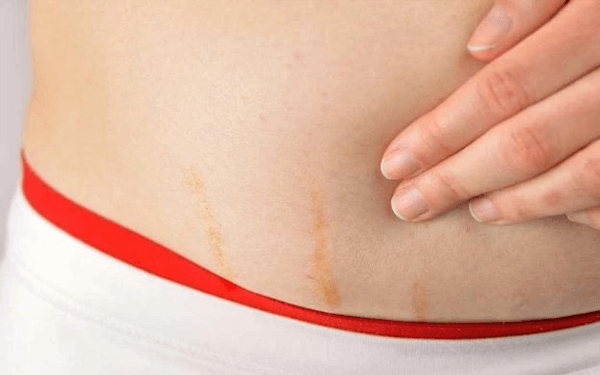 红色妊娠纹和白色妊娠纹的区别只是在颜色上吗？