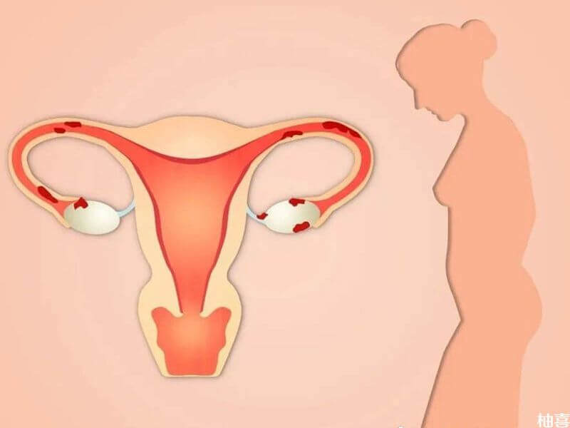 盆腔急性炎会导致输卵管性不孕