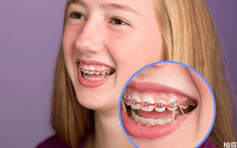 牙齿的3个最佳矫正年龄成人与儿童时间上有区别