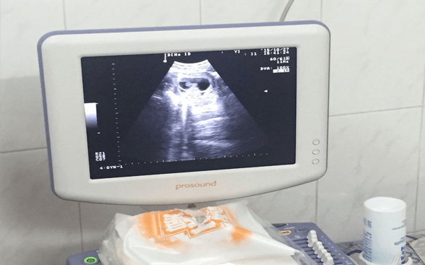 孕期b超报告单上的原始心管搏动就是指胎心吗？