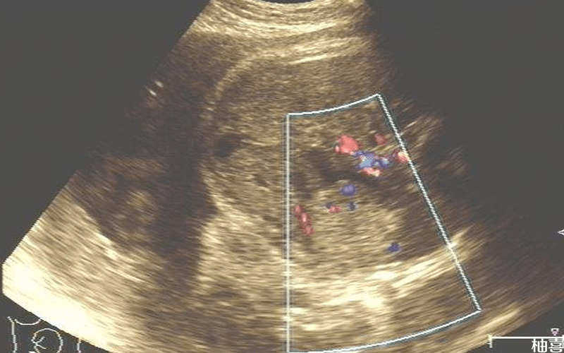 胎儿双顶径示意图
