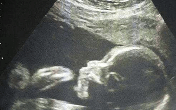 胎儿的双顶径有区别，结合股骨长可判断生男孩女孩