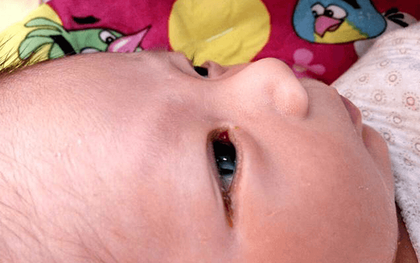 求有经验的宝妈分享下婴儿泪囊堵塞最好的解决办法?