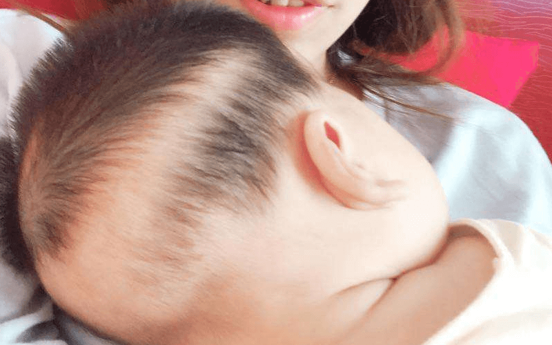 婴儿枕秃可能由于皮肤瘙痒导致