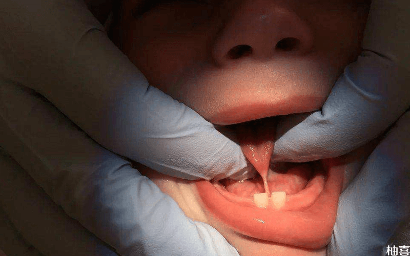 舌系带手术示意图