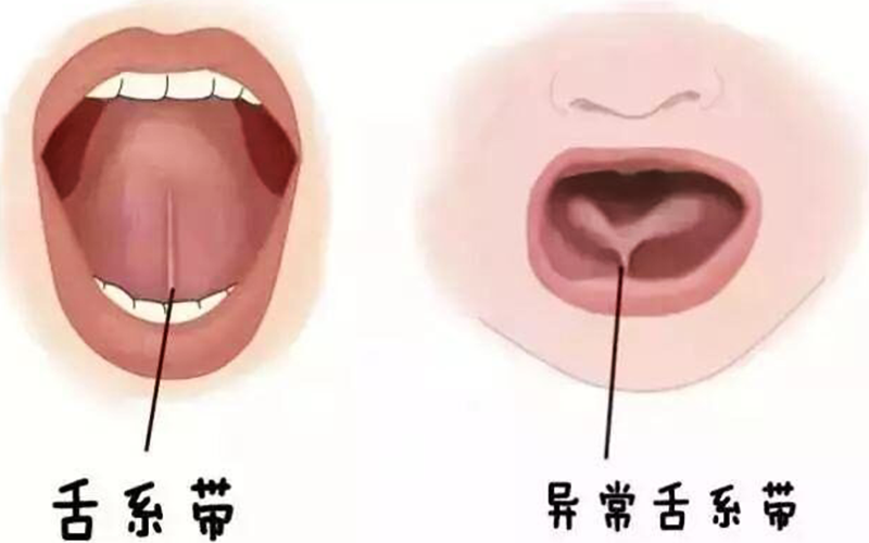 舌系带短需要进行手术