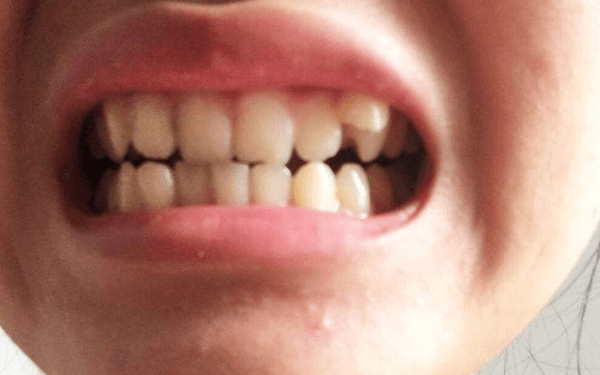 虎牙矫正的各个方法盘点，不拔牙也能拥有一口好牙