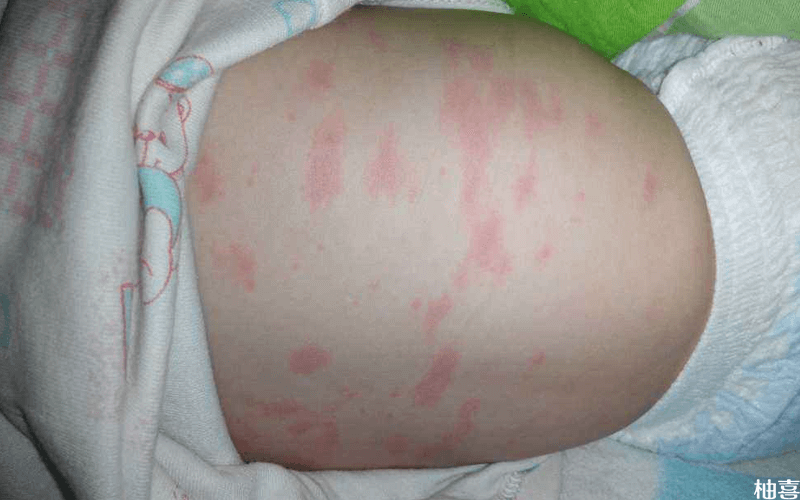 幼儿急疹出的疹子图片图片