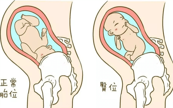 胎儿从孕中期到孕晚期一直是臀位，说明宝宝有问题吗？