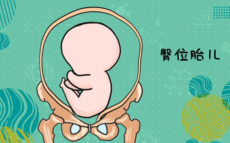 胎儿臀位是一种比较普遍的不正常胎位