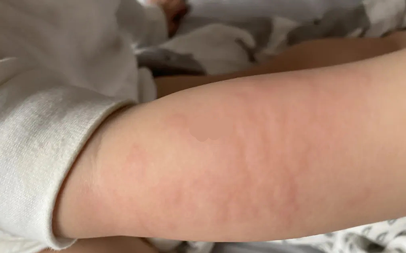 急疹期间要注意孩子的皮肤清洁